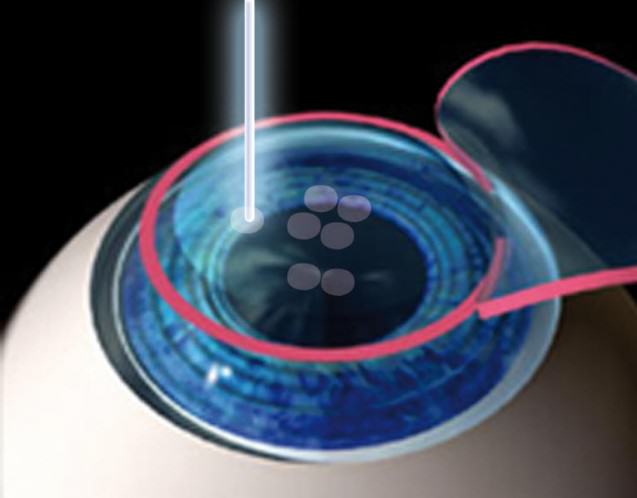 Refractive surgery and Excimer laser