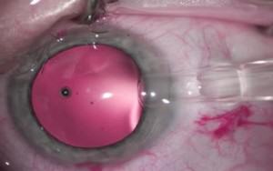 Implantation of phakic lens (1)