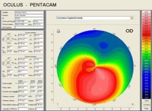 Topografía corneal para el diagnóstico del queratocono
