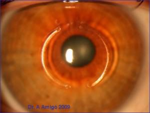Double intracorneal rings implanted at the IOA  to treat keratoconus