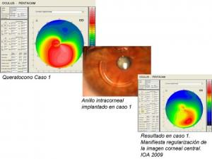 A case of keratoconus treated with intracorneal rings