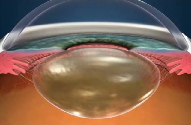 ¿Es el cristalino del ojo humano circular o elíptico? (y III)