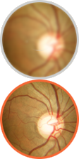 Diagnóstico y tratamiento del glaucoma