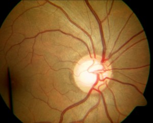 glaucoma1