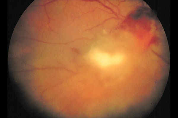 La Endoftalmitis puede causar ceguera y pérdida ocular
