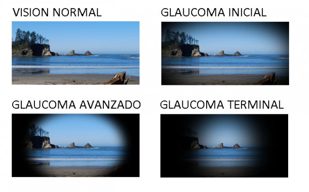 El glaucoma es el responsable del 12% de los casos de ceguera del mundo